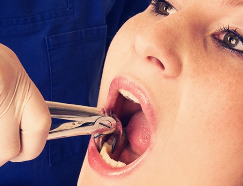 Home Care After Tooth Extraction